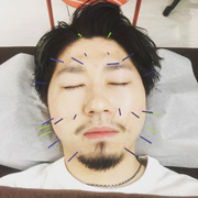 男性の美容鍼