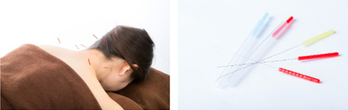 トリガーポイント鍼治療